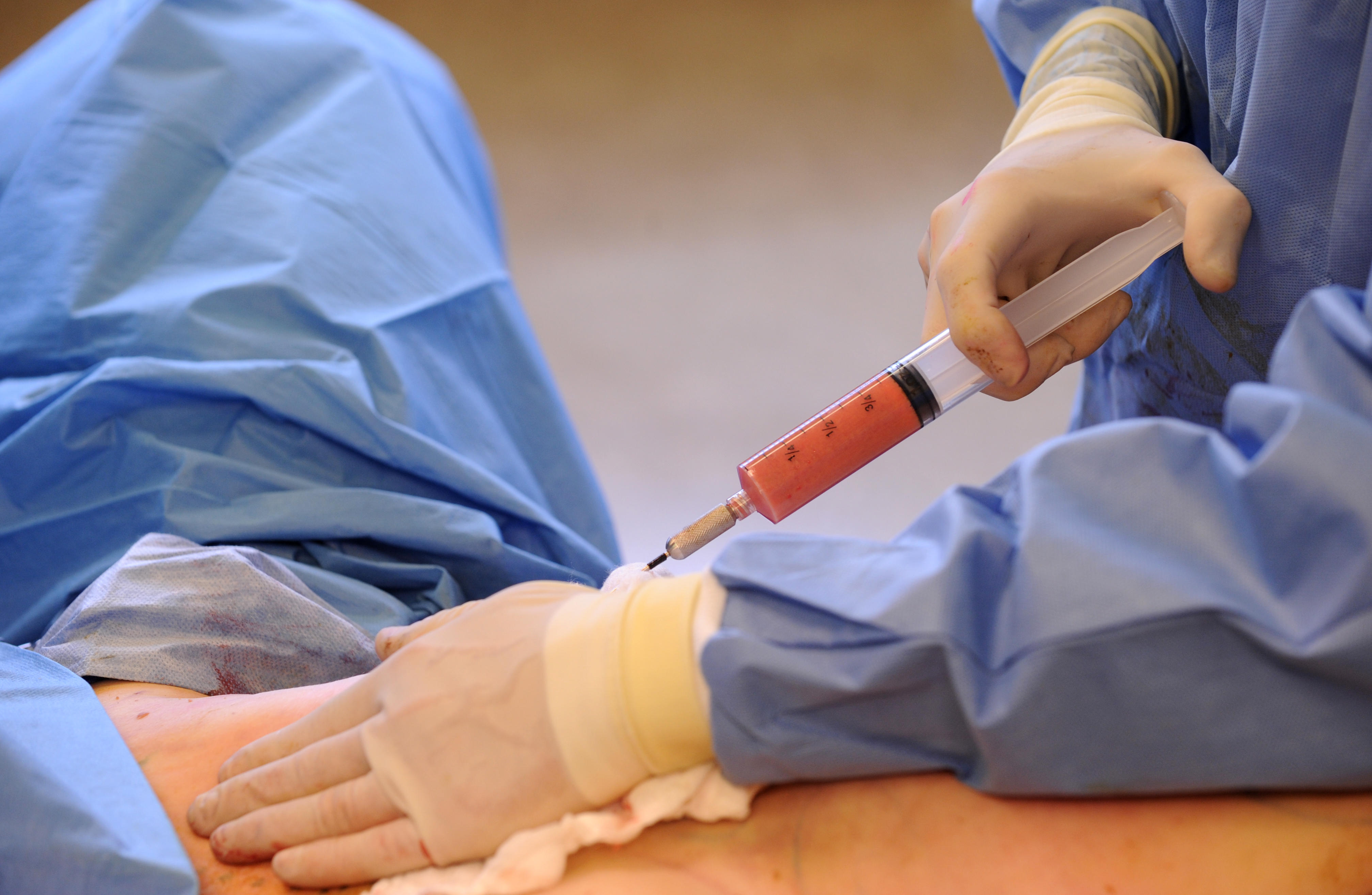 Triple board certified plastic surgeon Dr. David Broadway injects the fat from the back and buttocks back into the breasts of patient Sherri Frie. About 400 cubic centimeters of fat was re-injected into each breast. Each of these syringes holds about