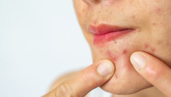 Close-up of woman pointing acne inflammation (Papule and Pustule) on her face.